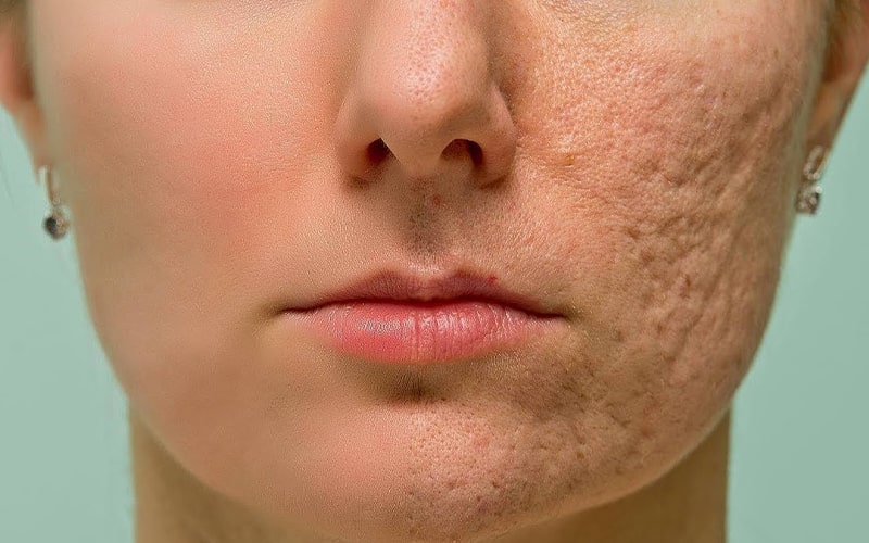 بررسی علت منافذ باز در پوست five reasons for open pores on the skin
